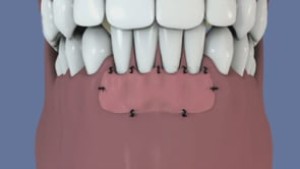 Greffe gingivale libre